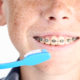 Young boy with dental braces and toothbrushes
