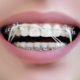 Closeup Dental Brackets with Rubber Elastic Band. Open Female Mouth with Self-ligating Braces. Orthodontic Treatment.