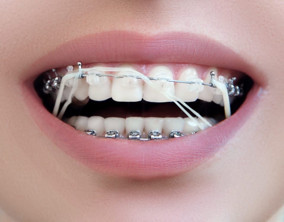 Closeup Dental Brackets with Rubber Elastic Band. Open Female Mouth with Self-ligating Braces. Orthodontic Treatment.